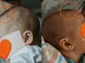 Dwa ujęcia głowy noworodka, pokazujące jego delikatne włosy i uszy.