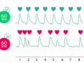 Dwa wykresy EKG z serduszkami. Górny pokazuje 60 BPM z zielonym znacznikiem, dolny 60 BPM z czerwonym. Puls u dziecka może być monitorowany na różne sposoby.