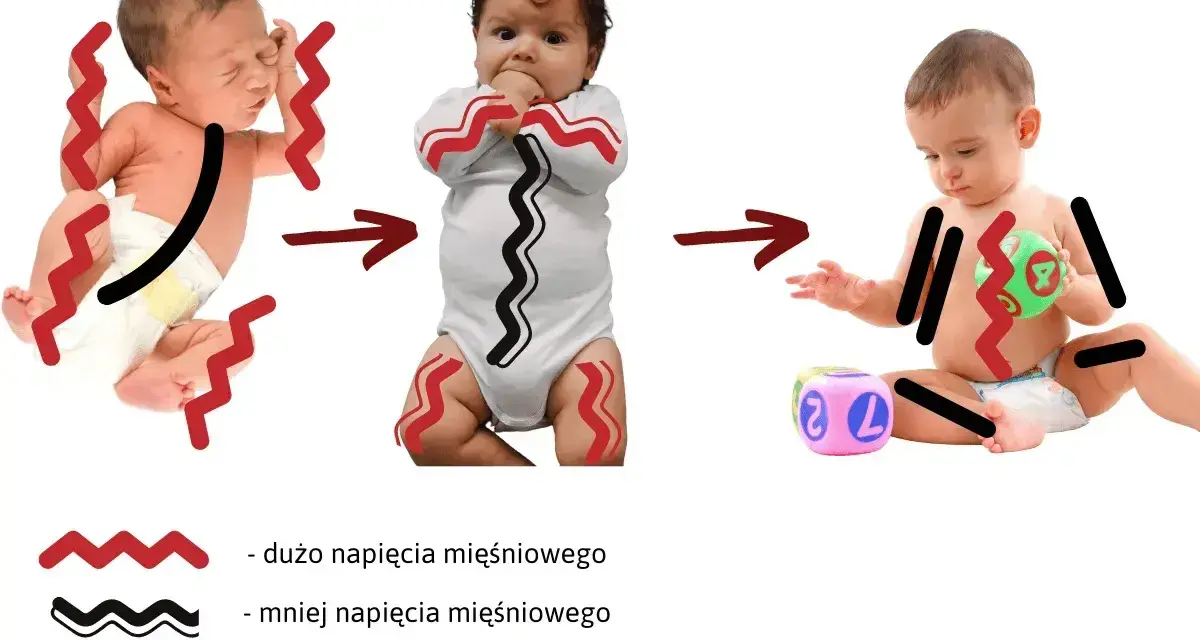 Trzy niemowlęta ilustrujące hipotonię mięśniową: od nadmiernego napięcia, przez umiarkowane, do niskiego.