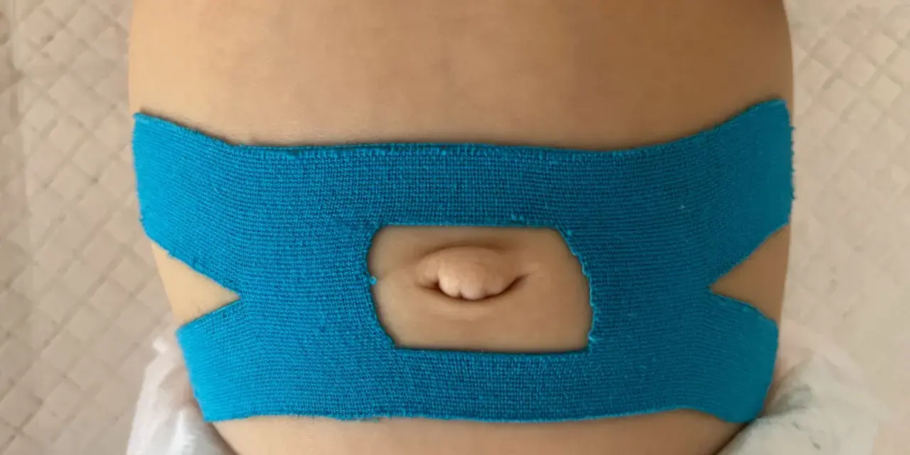 Niebieska taśma kinesiotapingowa na brzuszku niemowlaka, otaczająca pępek.