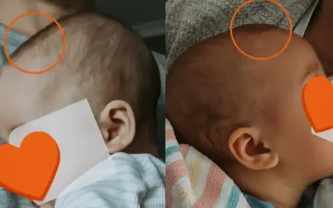 Dwa ujęcia głowy noworodka, pokazujące jego delikatne włosy i uszy.