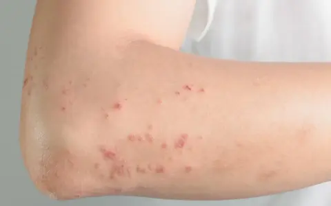 Skóra ramienia z licznymi, czerwonymi zmianami, które mogą być objawem pokrzywki w ciąży.