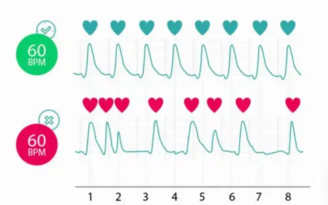 Dwa wykresy EKG z serduszkami. Górny pokazuje 60 BPM z zielonym znacznikiem, dolny 60 BPM z czerwonym. Puls u dziecka może być monitorowany na różne sposoby.