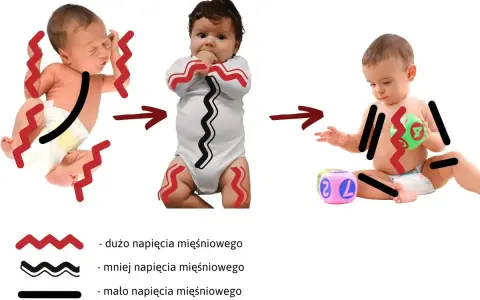 Trzy niemowlęta ilustrujące hipotonię mięśniową: od nadmiernego napięcia, przez umiarkowane, do niskiego.