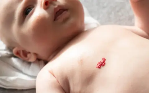 Czerwony naczyniak u noworodka na klatce piersiowej, przypominający małego ludzika.