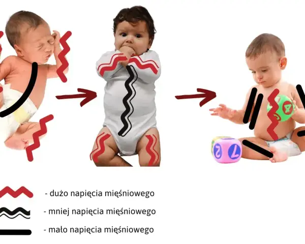 Trzy niemowlęta ilustrujące hipotonię mięśniową: od nadmiernego napięcia, przez umiarkowane, do niskiego.