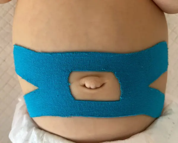 Niebieska taśma kinesiotapingowa na brzuszku niemowlaka, otaczająca pępek.