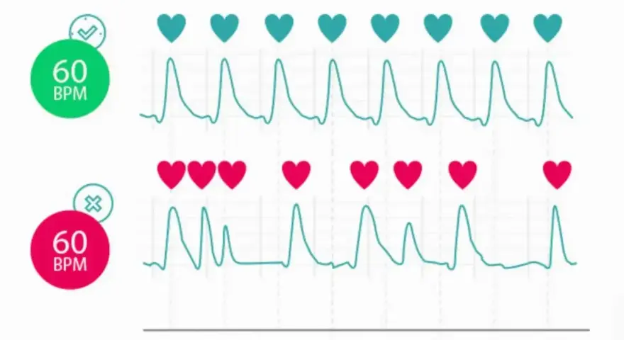 Dwa wykresy EKG z serduszkami. Górny pokazuje 60 BPM z zielonym znacznikiem, dolny 60 BPM z czerwonym. Puls u dziecka może być monitorowany na różne sposoby.