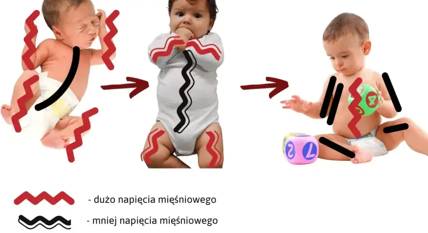 Trzy niemowlęta ilustrujące hipotonię mięśniową: od nadmiernego napięcia, przez umiarkowane, do niskiego.