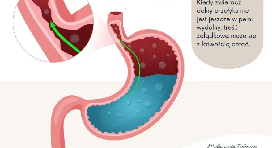 Ilustracja pokazuje żołądek i przełyk, wyjaśniając mechanizm refluksu ukrytego u niemowlaka.