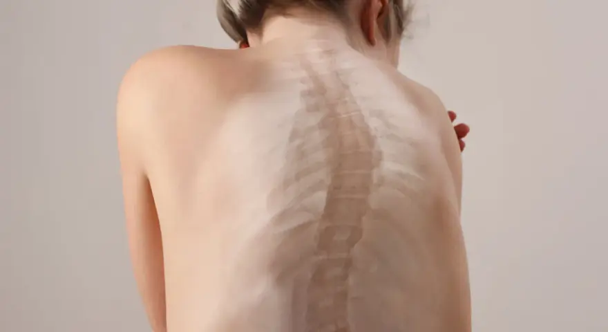 Widok z tyłu na plecy dziecka, gdzie widoczne są wystające kręgi kręgosłupa.