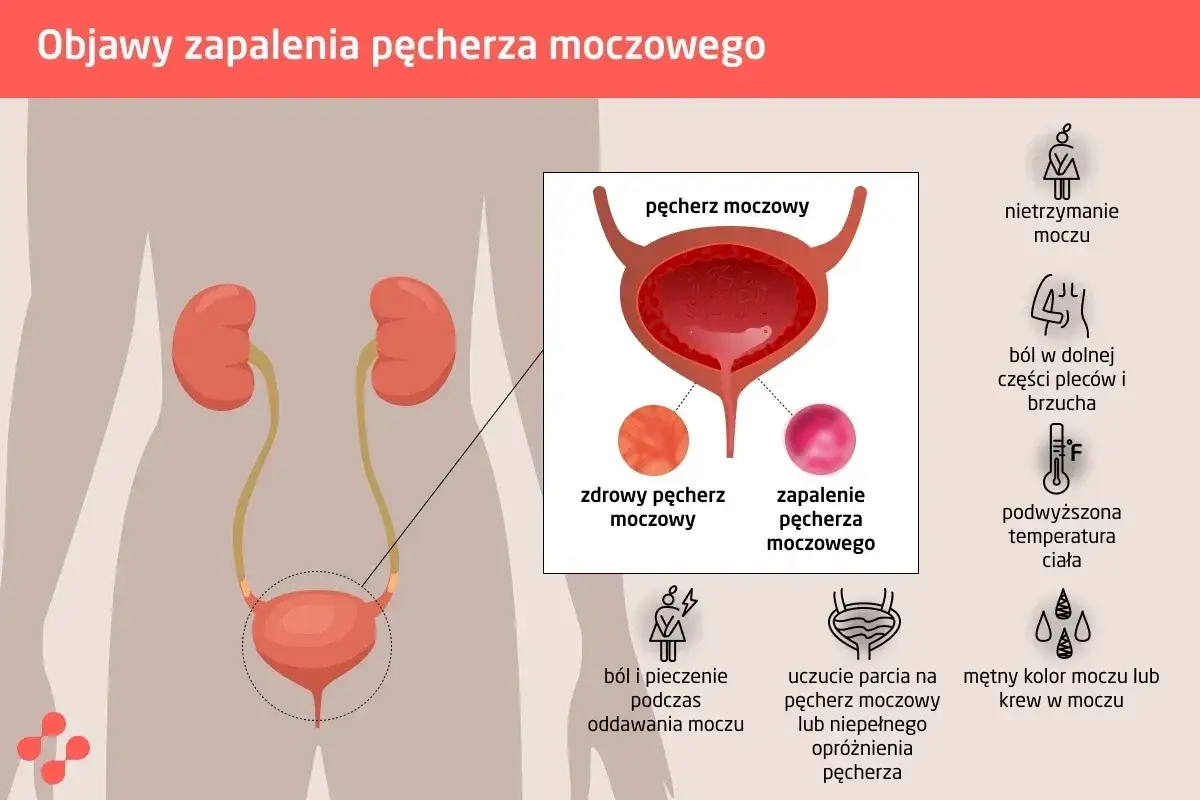 Ilustracja przedstawia objawy zapalenia dróg moczowych u dziecka: ból, pieczenie, nietrzymanie moczu, gorączkę i zmętniały mocz.