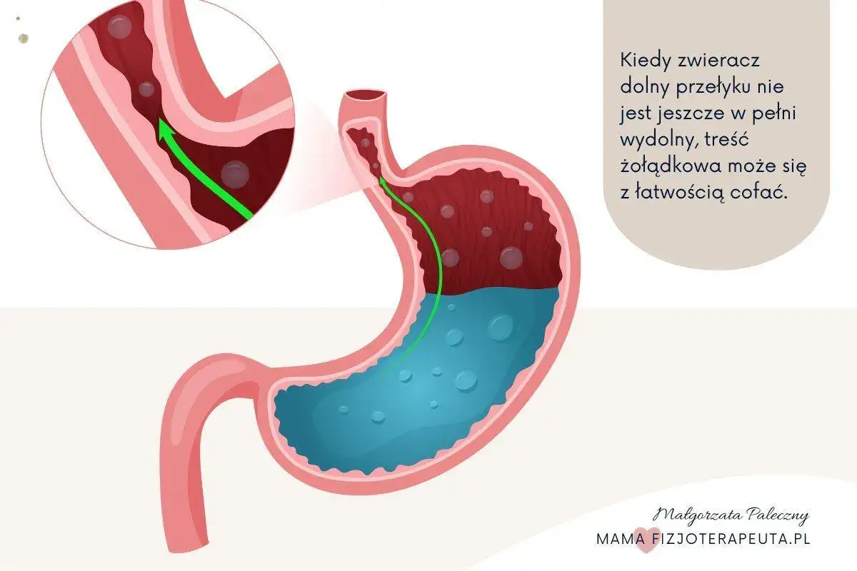 Ilustracja pokazuje żołądek i przełyk, gdzie treść żołądkowa cofa się do g&oacute;ry. To wyjaśnia, jak może wyglądać refluks ukryty u niemowlaka.