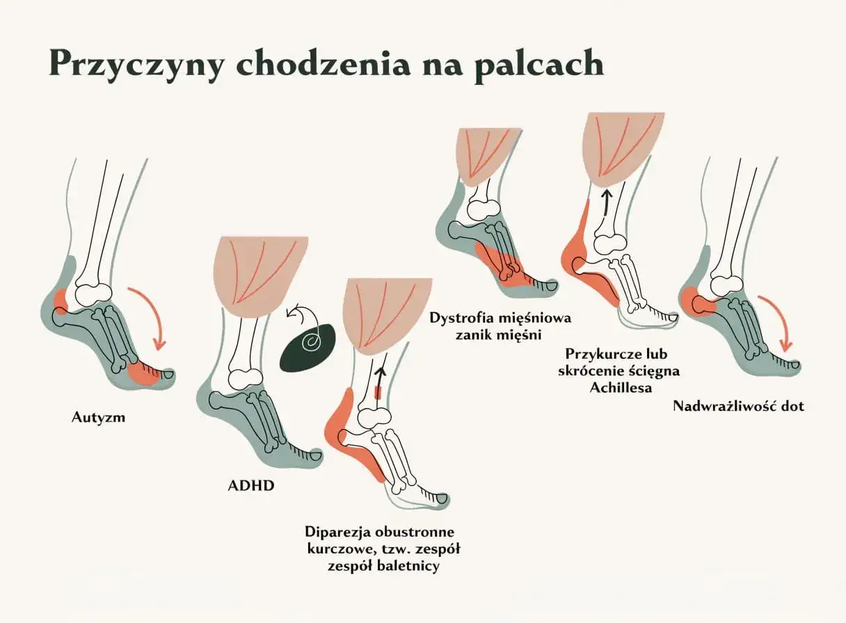 Ilustracja pokazuje, jak 10-letnie dziecko chodzi na palcach z powodu autyzmu, ADHD, dystrofii mięśniowej, przykurczu ścięgna Achillesa lub nadwrażliwości dotykowej.