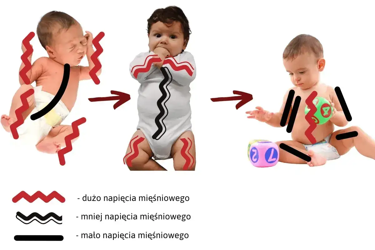 Trzy niemowlęta ilustrujące obniżone napięcie mięśniowe: od wysokiego do niskiego.